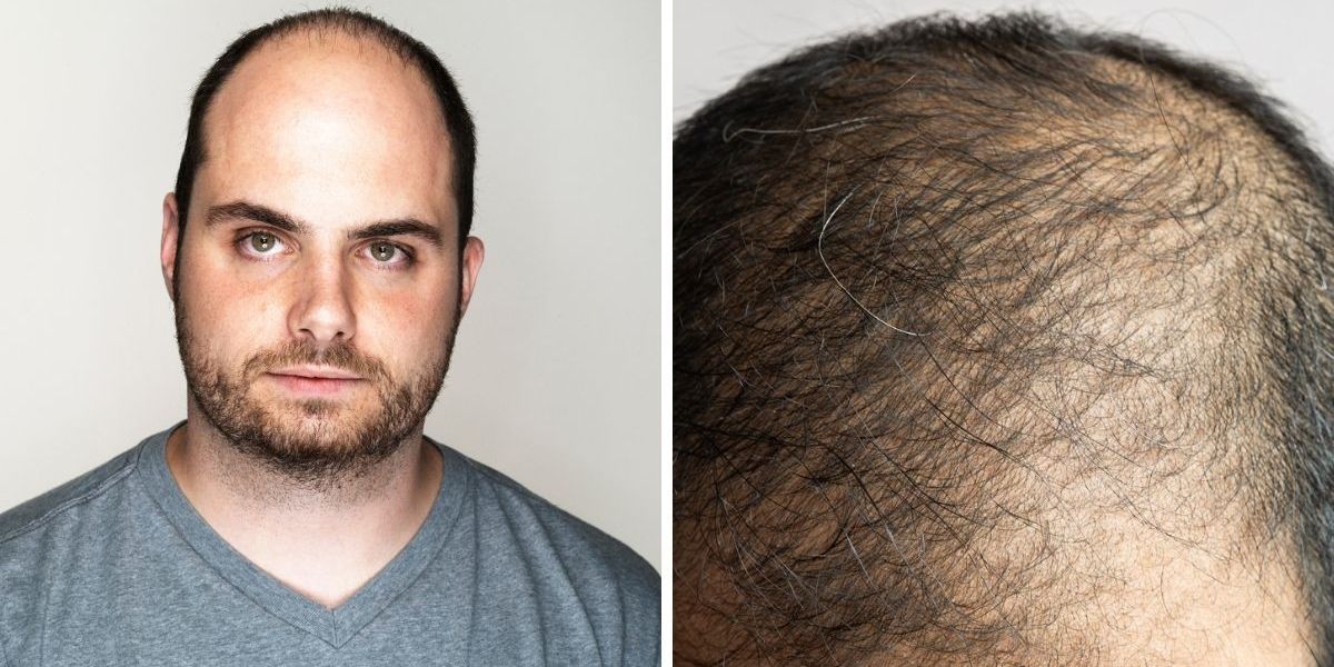 ‘The fresh start I needed’: Hair replacement systems can be life-changing for men who are losing their hair