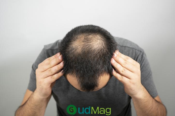 Roots Start to Show for Hair Loss Startup Pelage With a Peek at First Clinical Data – MedCity News – GudMag