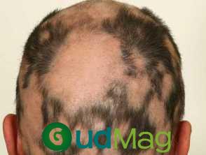 Integrated Data From BRAVE-AA1 and BRAVE-AA2 Trials Supports Efficacy of Baricitinib Over 104 Weeks in Alopecia Areata – GudMag